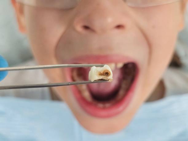 Best Chipped Tooth Repair Near Me  in Spurgeon, TN